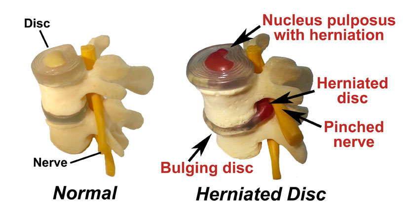Cause of sciatic nerve pain - herniated disc