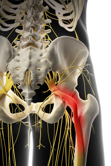 sciatica nerve pain